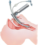intubatie